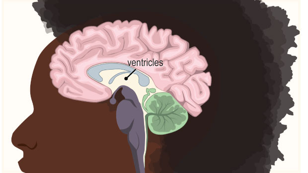These hollow spaces in the brain have cerebral spinal fluid (CSF) in them. CSF flows through the ventricles and around the spine in the spinal column, protecting and nourishing the central nervous system.