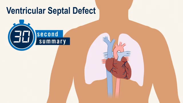 30-Second Summary: Ventricular Septal Defect
