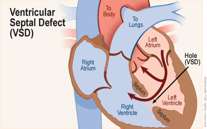 Cross section diagram of the heart shows a ventricular septal defect (VSD) — some blood flows normally from the left atrium into the left ventricle, then on to the aorta.  But a hole in the septum (VSD) also allows blood flow directly from the left ventricle into the right ventricle.