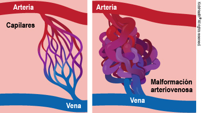 Se muestra una arteria y una vena conectadas por capilares y una arteria y una vena con una malformación arteriovenosa en la conexión.