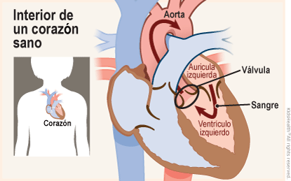 Se muestran dos ilustraciones. Una ilustración muestra la posición del corazón en el cuerpo y la otra un primer plano del corte transversal de un corazón sano. La sangre fluye de la aurícula izquierda al ventrículo izquierdo y desde allí pasa por una válvula y se dirige hacia la aorta. 