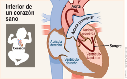 Se muestran dos ilustraciones. Una muestra la posición del corazón en el cuerpo y la otra un primer plano de un corte transversal de un corazón sano. La sangre fluye desde la aurícula izquierda hacia el ventrículo izquierdo y, a través de una válvula, llega a la aorta. 