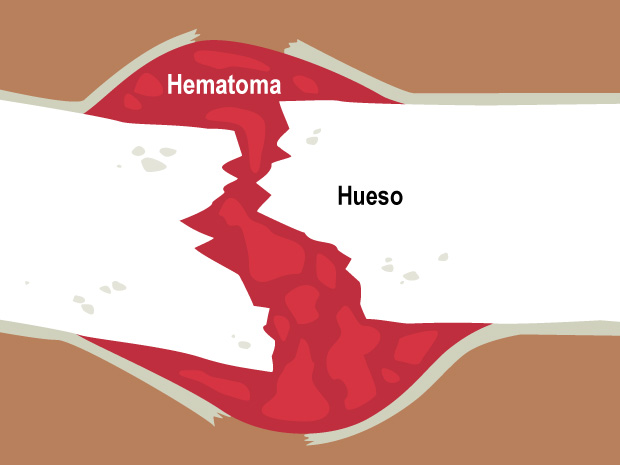 Formación del hematoma
